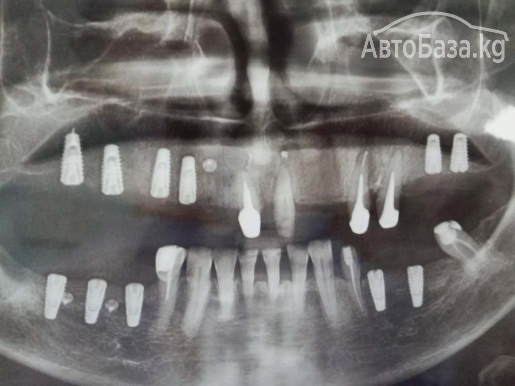 Имплантация зубов под ключ